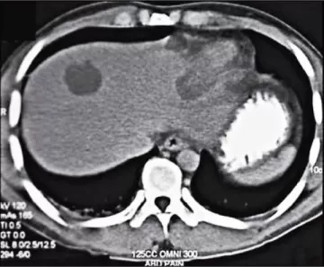 Амебиаз - симптомы и лечение