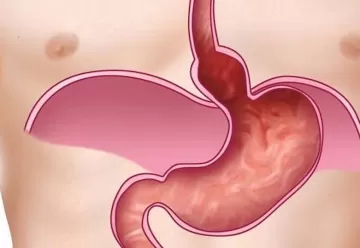 Грыжа пищеводного отверстия диафрагмы