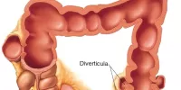 Дивертикулез толстой кишки