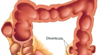 Дивертикулез толстой кишки