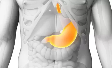 Гастроптоз