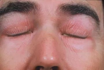 Дерматомиозит