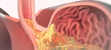 Гастроэзофагеальный рефлюкс