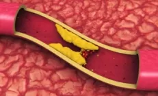 Повышенный холестерин: причины, риски и методы нормализации