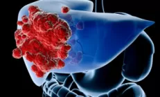 Операция по пересадке печени в Израиле. Что нужно знать.