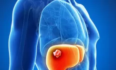 Учёные: У некоторых людей клетчатка повышает риск рака печени