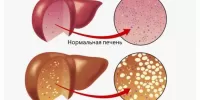 Жировая дистрофия печени: причины, симптомы, лечение болезни
