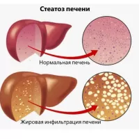 Жировая дистрофия печени: причины, симптомы, лечение болезни