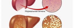 Жировая дистрофия печени: причины, симптомы, лечение болезни