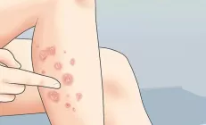 Гепатолог: У пациентов с псориазом повышен риск жирового гепатоза и цирроза печени