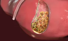 Камни в желчном пузыре и холецистэктомия способствуют развитию стеатоза печени