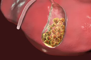 Камни в желчном пузыре и холецистэктомия способствуют развитию стеатоза печени