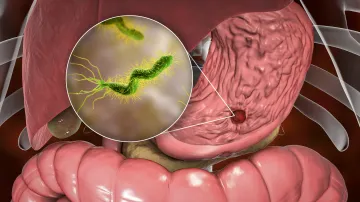 Обнаружен способ, с помощью которого Helicobacter pylori «запускает» рак желудка