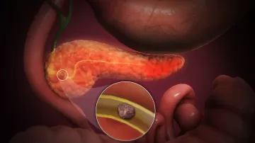 Панкреатит и камни в желчном пузыре: гастроэнтеролог отвечает на главные вопросы