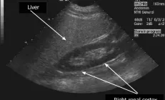Что показывает УЗИ печени и кому его нужно сделать? Отвечает врач-гепатолог