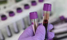 Британские учёные выяснили, какая группа крови связана с ожирением печени