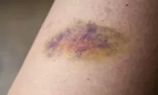 Почему у меня так много синяков? 5 возможных причин