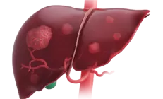 Учёные поняли, как обнаружить рак желчных протоков на ранней стадии