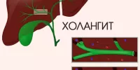 Склерозирующий холангит: причины, симптомы, диагностика и лечение