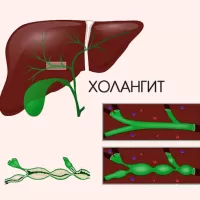Склерозирующий холангит: причины, симптомы, диагностика и лечение