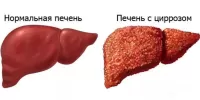 Цирроз печени: симптомы, диагностика и лечение
