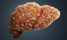 Гепатолог назвала признаки кровотечения у пациентов с циррозом печени