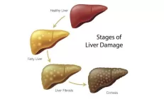 У людей с высоким сахаром в крови быстрее прогрессирует ожирение печени
