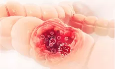 Учёные: НАЖБП повышает риск рака печени, кишечника и молочной железы