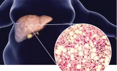 Жировая болезнь печени в 17 раз повышает риск рака
