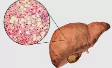 Заболеваемость жировым гепатозом в мире выросла в 3 раза