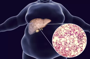 Стеатоз печени ускоряет рост опухоли при раке кишечника