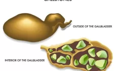 У пациентов с желчными камнями после операции снижается риск инсульта