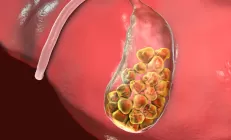 Терапевт Лазуренко объяснила, какие продукты вредят желчному пузырю