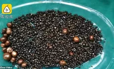 Врачи обнаружили у любительницы фастфуда 2000 камней в желчном пузыре