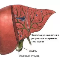 Холестаз: причины, симптомы и лечение