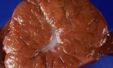 Фокальная нодулярная гиперплазия печени: симптомы, диагностика и лечение