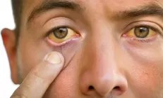 Ложная желтуха: когда кожа желтеет без болезни?