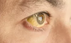 Гастроэнтеролог рассказала, почему кожа и слизистые желтеют