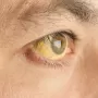 Желтуха — это опасный симптом? Профессор Маевская отвечает, как быстро нужно обратиться к врачу
