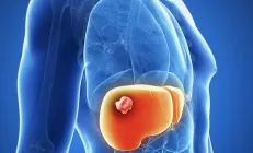 Учёные выяснили, как без операции остановить рост раковой опухоли в печени