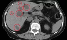 Метастазы в печени: симптомы, диагностика и лечение
