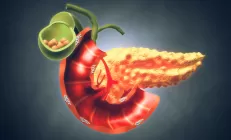 Признаки рака поджелудочной железы: характерные изменения в стуле