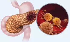 Учёные выяснили, почему рак поджелудочной железы высоко агрессивен