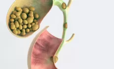 Что может случиться с желчным пузырём: топ-5 болезней