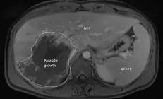 Пациентка «готовилась умереть» от рака печени. Но оказалось, что в ней живёт огромный паразит