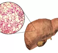 Неалкогольная жировая болезнь печени (НАЖБП/МАЖБП): причины, симптомы, лечение болезни