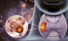 Учёные: Ожирение печени повышает риск рака щитовидной железы