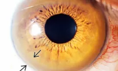 Болезнь Вильсона-Коновалова: симптомы, диагностика и лечение