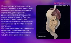 Холецистит