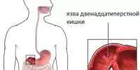 Язва двенадцатиперстной кишки